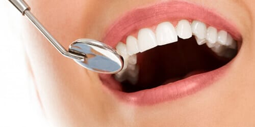 Отбеливание зубов